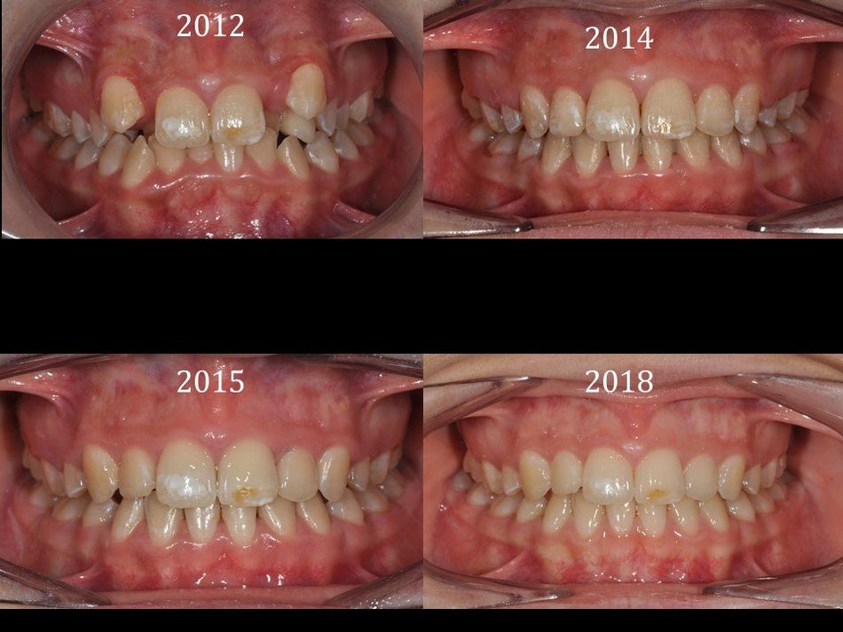 confronto dentatura dopo cure
