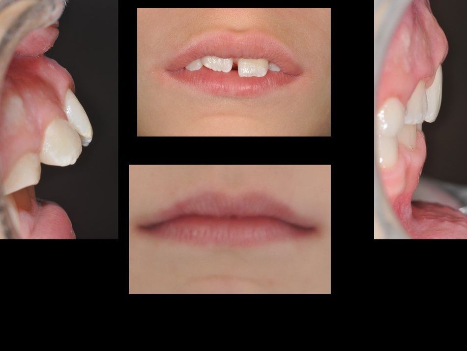 denti riallineati