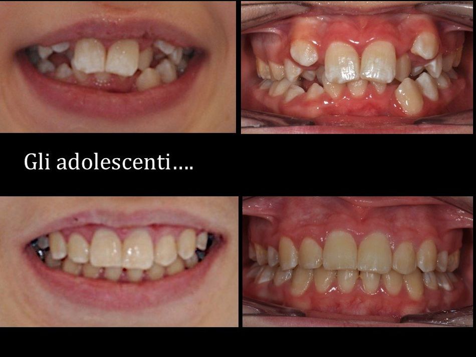denti storti