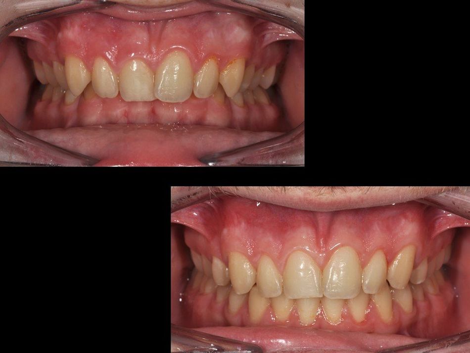 denti sbiancati