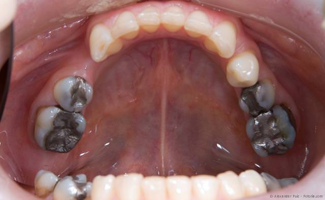 Amalgam kann der Auslöser für viele Störungen und Erkrankungen sein. Amalgam kann der Auslöser für viele Störungen und Erkrankungen sein.