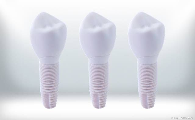 Keramik-Implantate aus Zirkondioxid: Gut körperverträglich Keramik-Implantate aus Zirkondioxid: Gut körperverträglich