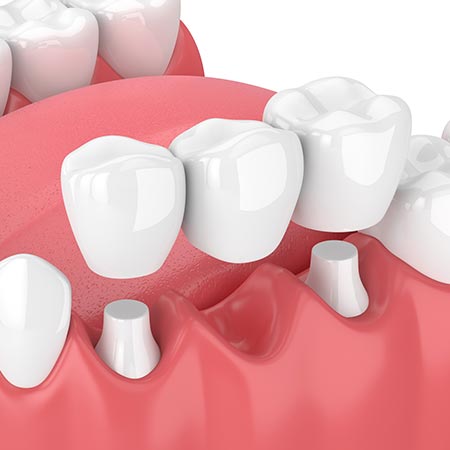 Bridges — Huntsville, AL — Inspiring Smiles Family Dentistry