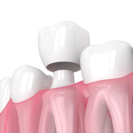 Crowns — Huntsville, AL — Inspiring Smiles Family Dentistry