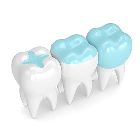 Fillings — Huntsville, AL — Inspiring Smiles Family Dentistry