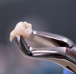 Dental Extraction — Dentist Port Orange in South Daytona, FL