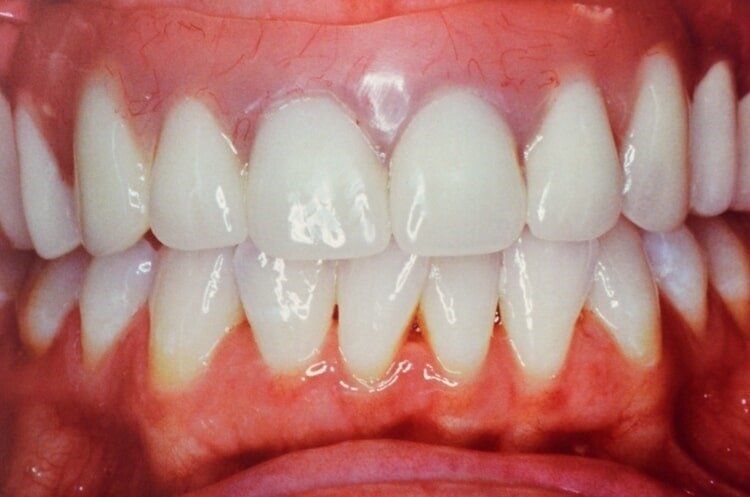 After Dental Implant — Dentist Port Orange in South Daytona, FL