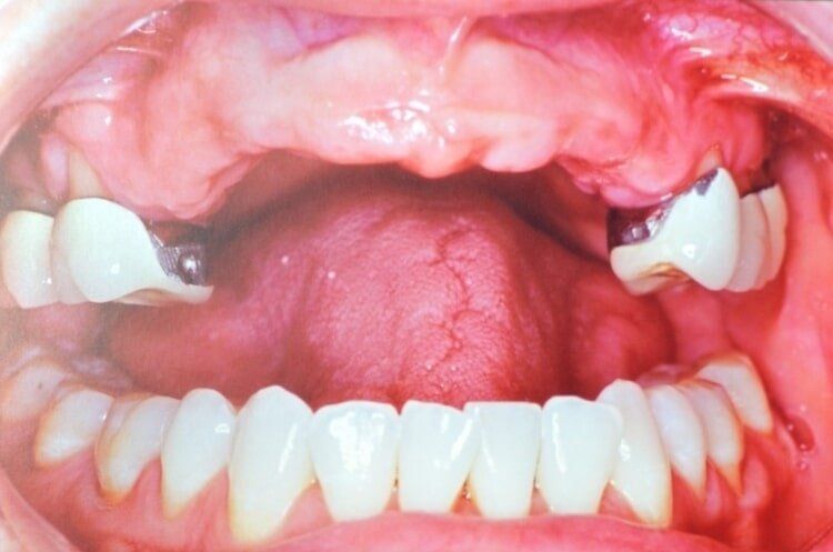 Before Dental Implant — Dentist Port Orange in South Daytona, FL