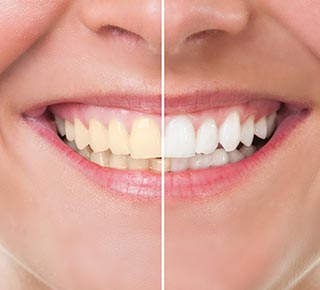 Teeth Whitening — Dentist Port Orange in South Daytona, FL Teeth Whitening — Dentist Port Orange in South Daytona, FL