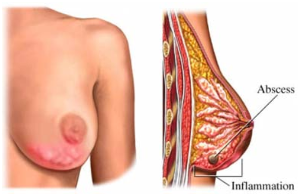 Breast Abscess photo