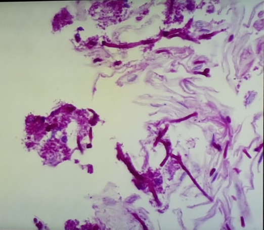 oesophagitis in children 