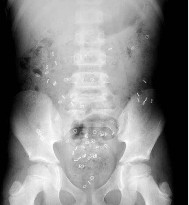 constipation in children colonic transit study