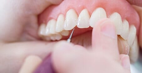 Invisalign — Braces in Banning, CA
