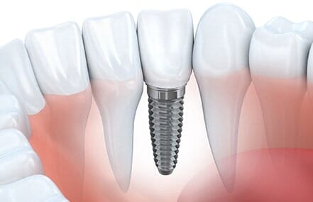 Guy with braces — Dental Implants in Banning, CA Guy with braces — Dental Implants in Banning, CA