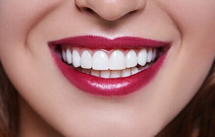 Veneer Teeth — Teeth Whitening in Banning, CA Veneer Teeth — Teeth Whitening in Banning, CA