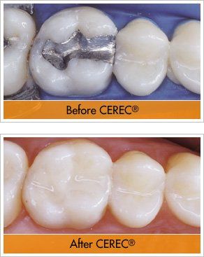 Ceramic Dental Restoration — CEREC Before & After in Evans, GA Ceramic Dental Restoration — CEREC Before & After in Evans, GA