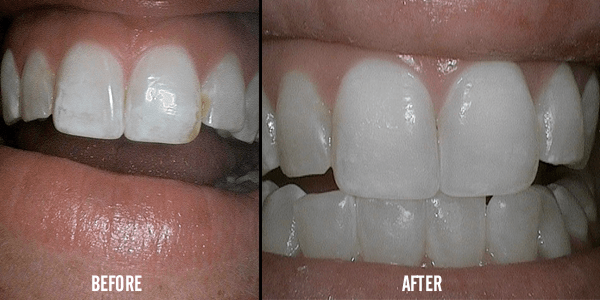 Teeth Whitening Services — Teeth Treatment in Evans, GA Teeth Whitening Services — Teeth Treatment in Evans, GA
