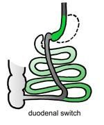 Diagram van een duodenale switch-procedure. Een deel van de maag wordt verwijderd en de dunne darm wordt omgeleid.