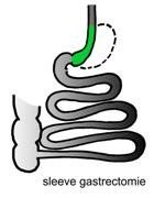 Diagram van een sleeve-gastrectomie, waarbij de maag (groen) en darmen vóór en na de operatie te zien zijn.