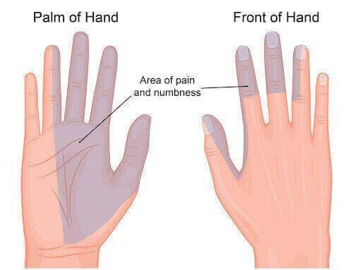 where carpal tunnel symptoms are
