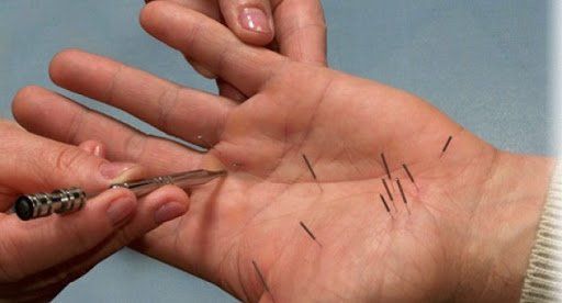acupuncture of the hand