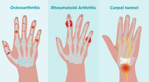 schematic of carpal tunnel and arthritis symptoms locations