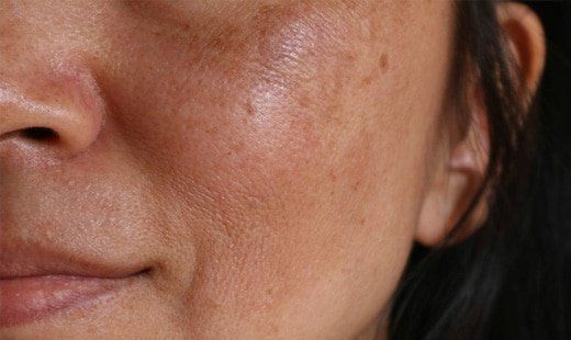 brown spots during pregnancy