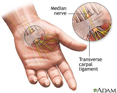 carpal tunnel surgery