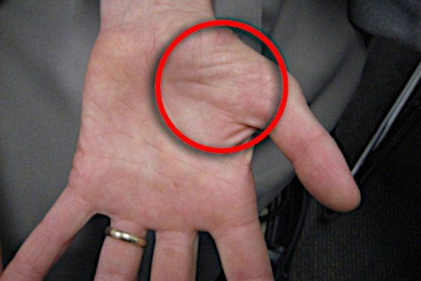 severe carpal tunnel