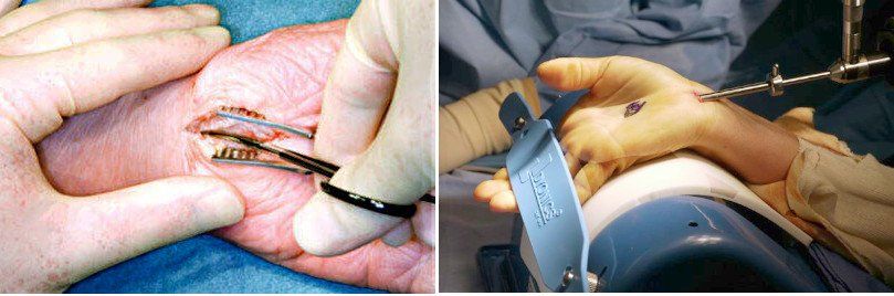 carpal tunnel surgery