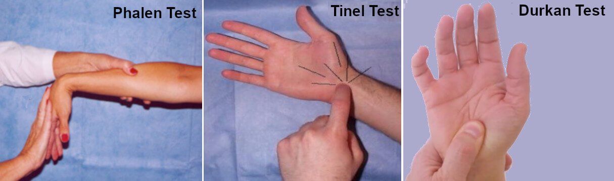 provocative tests for carpal tunnel