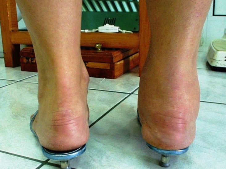cortisone flare in the ankle