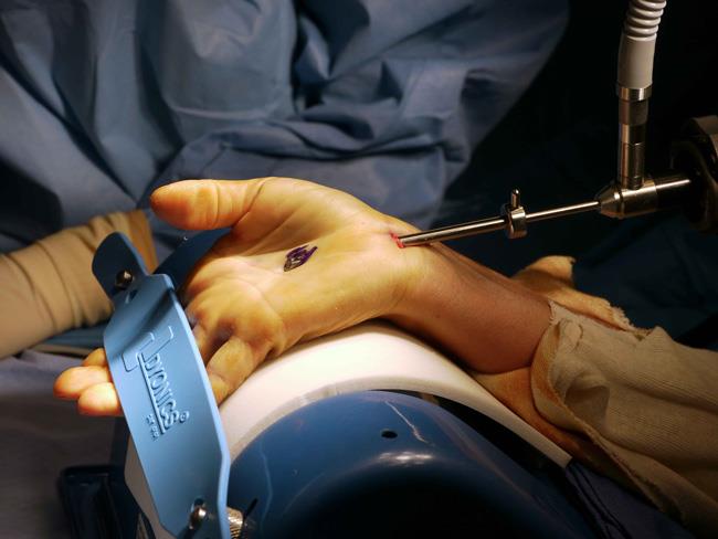 endoscopic carpal tunnel surgery
