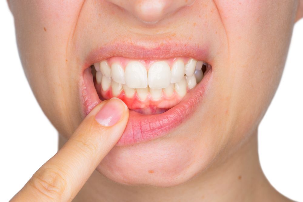 swollen gums