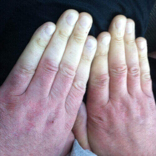 Raynaud syndrome