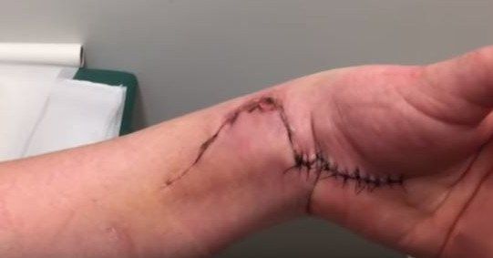 carpal tunnel surgery infection