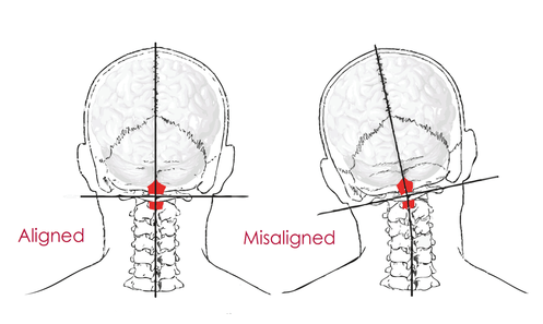 diagram of cervical spine misalignment