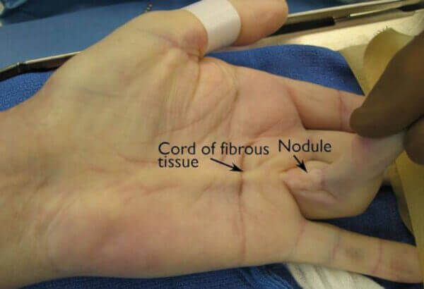 endoscopic carpal tunnel surgery