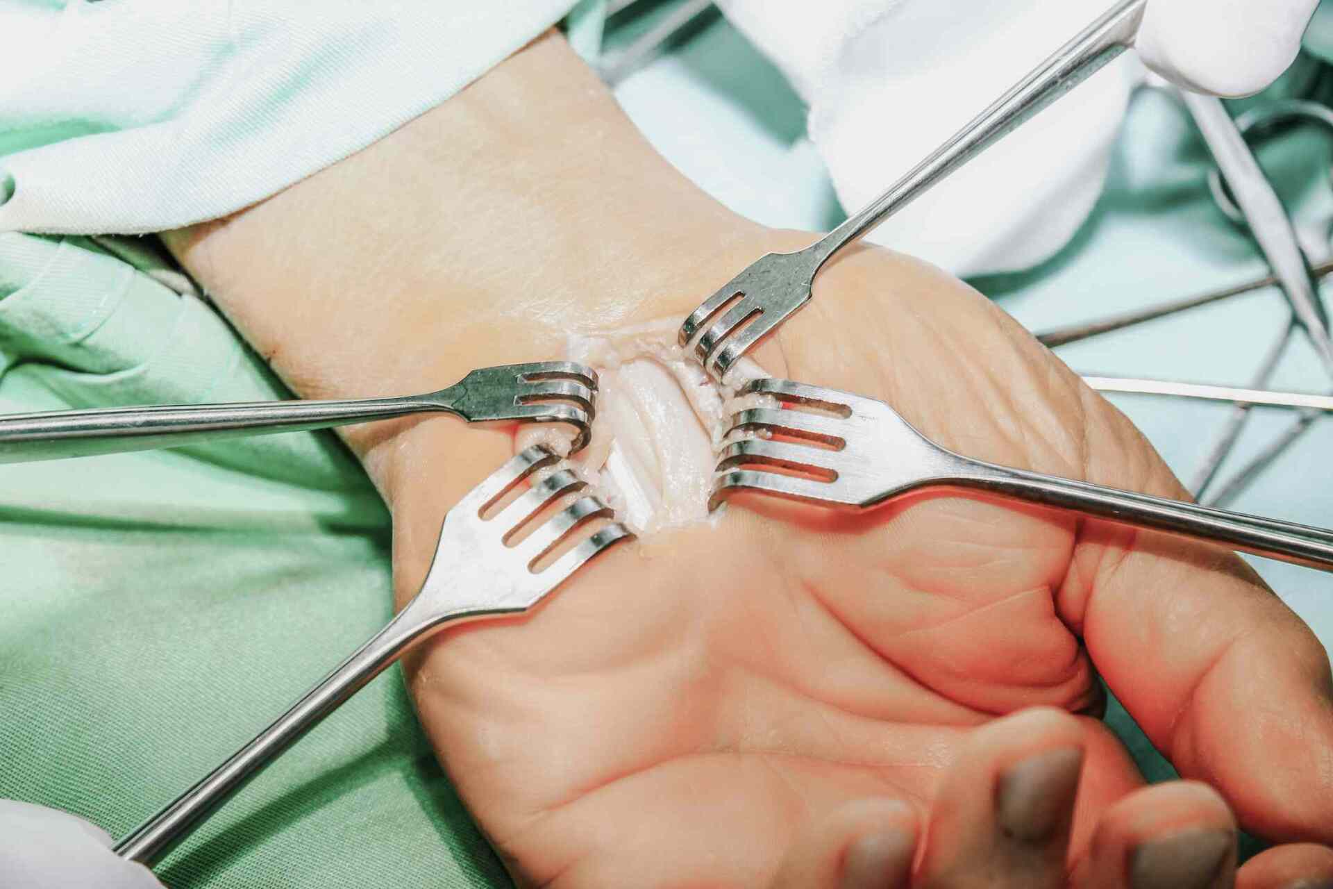carpal tunnel surgery