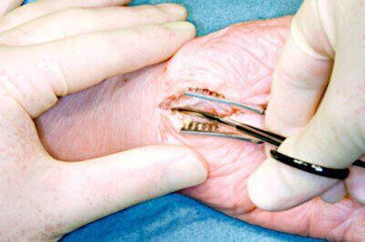 open release surgery