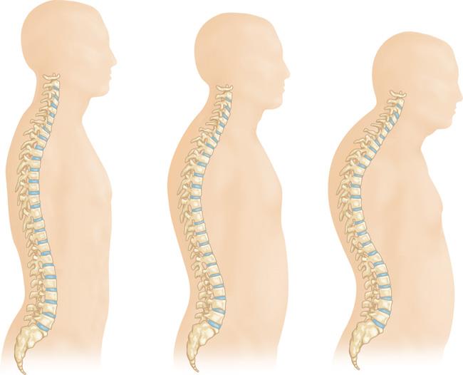 graphic of osteoporosis