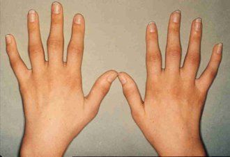 rheumatoid arthritis in the fingers