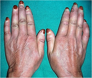 erythromelalgia and scleroderma in a woman's hands