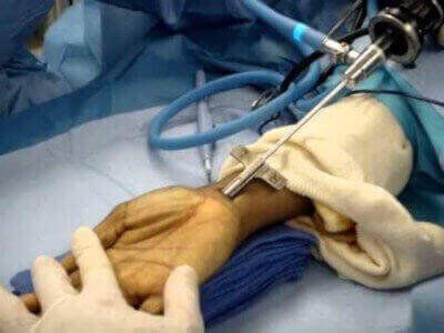 Cirurgia Endoscópica de Incisão Dupla para Liberação do Túnel do Carpo