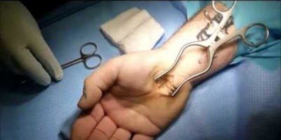 open carpal tunnel release surgery
