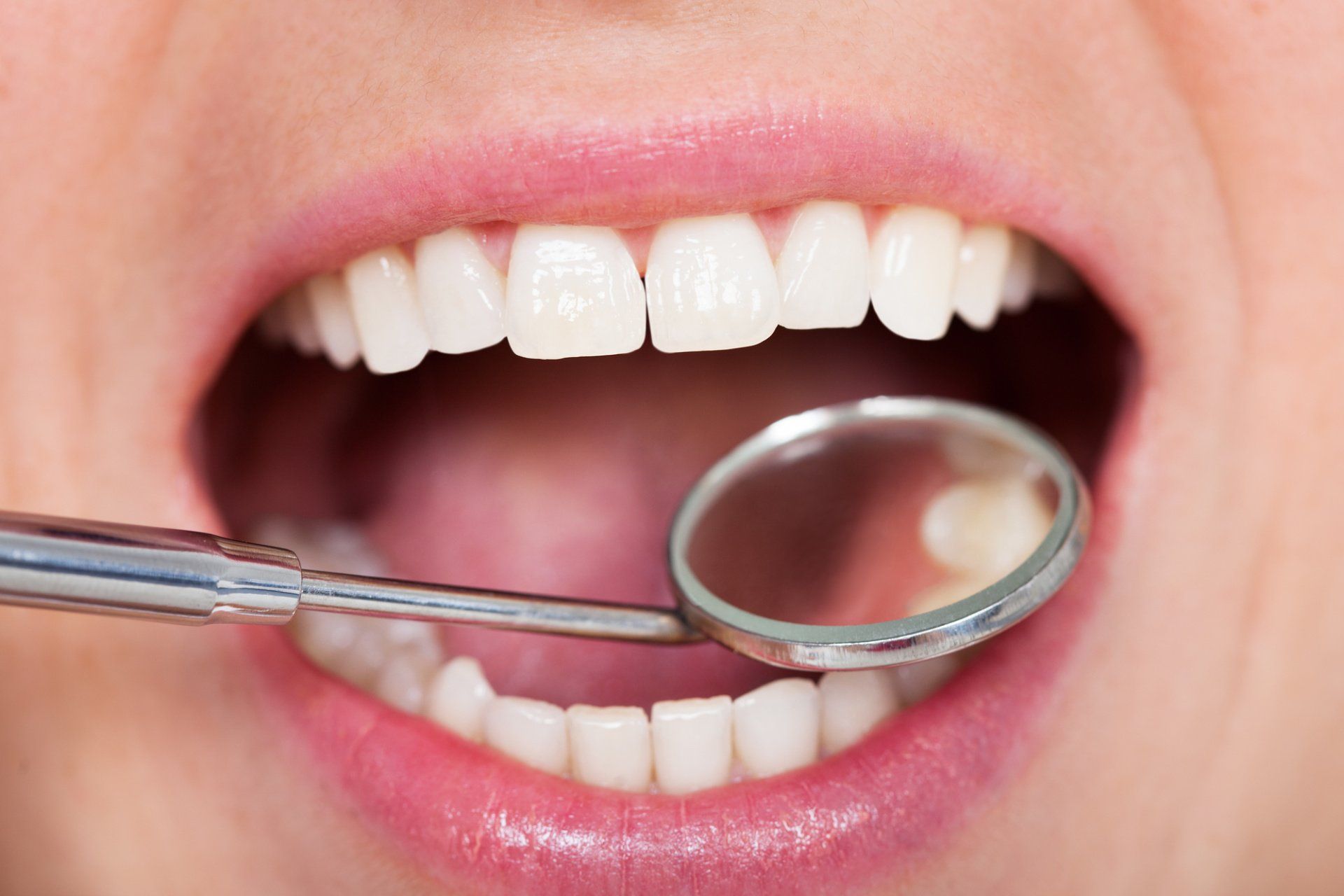 almaglam vs composite fillings