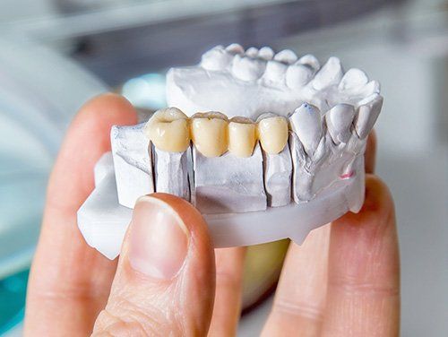 Hand holding a dental model with a bridge of false teeth in a light yellow color.
