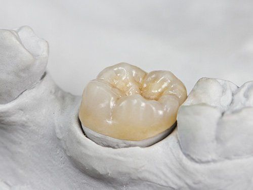A dental crown, light beige in color, sits in a white mold, showcasing a restored tooth.