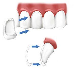 Illustration of a veneer fitting on a tooth. Arrows show the veneer being placed over a prepared tooth.