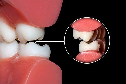 illustration of teeth out of place